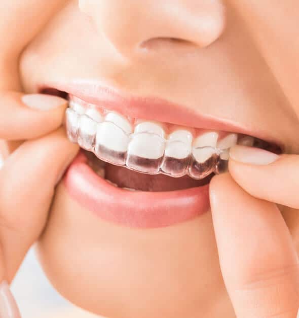 Invisalign® Bowling Green, Russellville, Tompkinsville