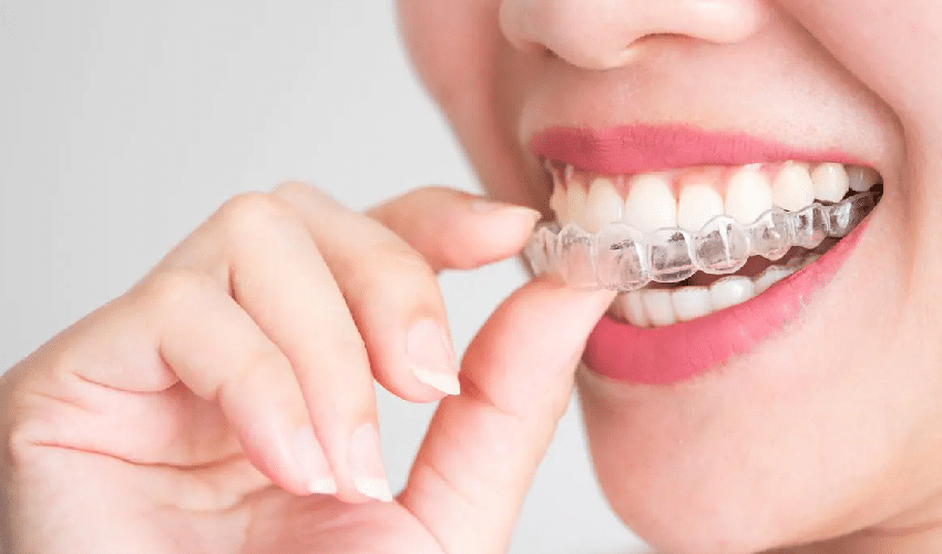 Featured image for “What You Need To Know About Teeth Straightening with Invisalign”