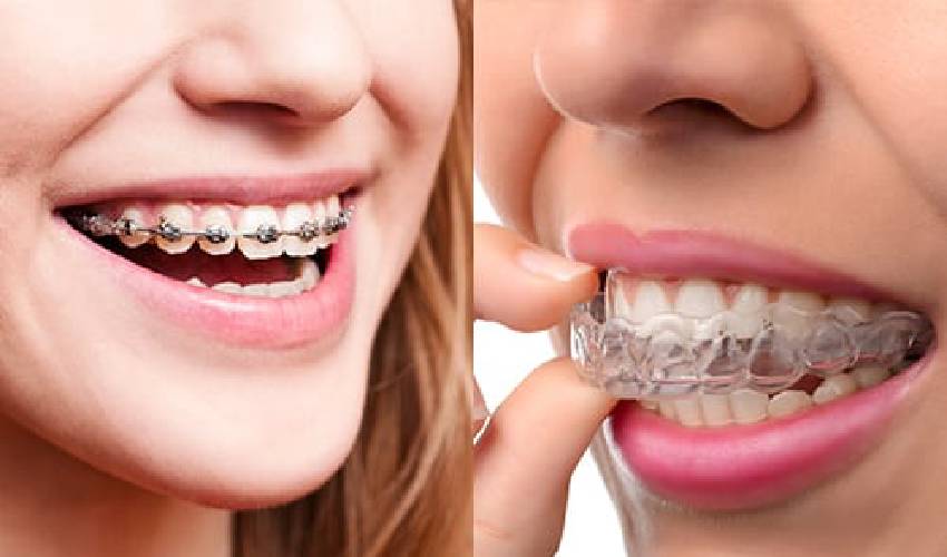 Featured image for “Invisalign Vs. Braces For Kids And Teens”