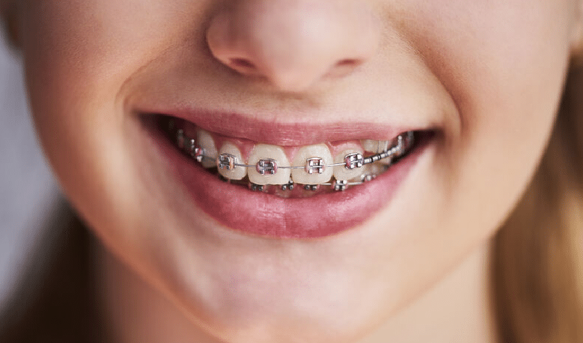 Featured image for “Why Get Braces – Understanding The Reasons”