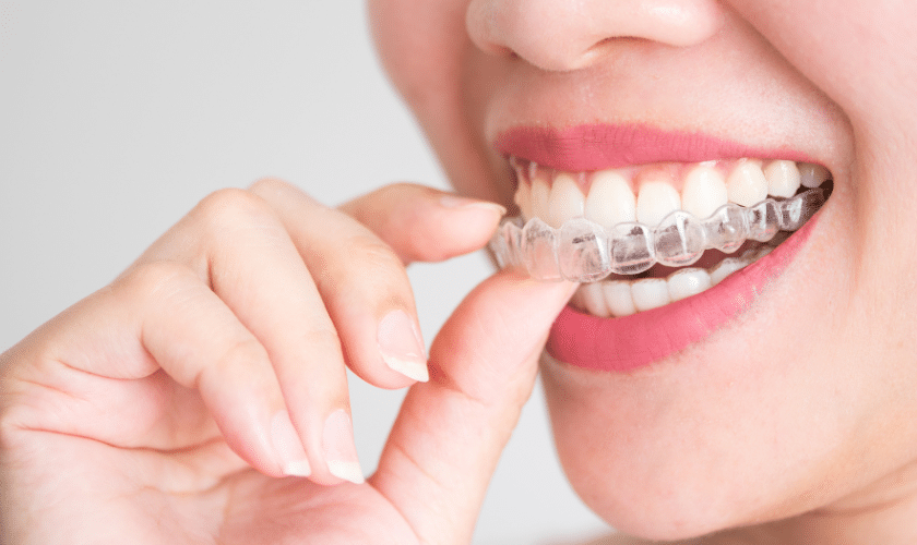 Featured image for “The Ultimate Invisalign Guide: What You Should Know Before Starting Treatment”