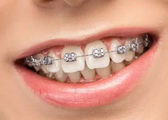 Braces Bowling Green