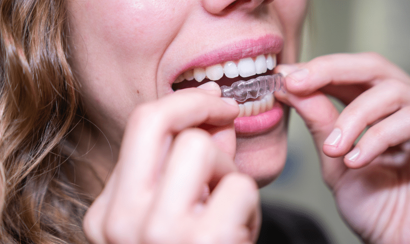 Featured image for “Embrace the Future of Orthodontics: Invisible Teeth Straightening with Invisalign Teen”
