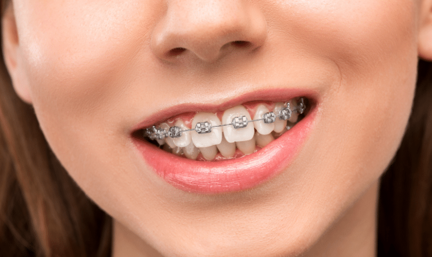 Featured image for “Life with Braces: Tips for Eating, Cleaning, and Managing Discomfort in Bowling Green”