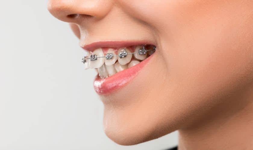 Featured image for “Choosing Between Braces and Clear Aligners: A Guide for Adults”