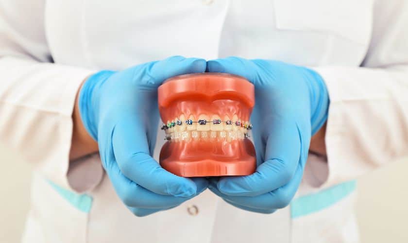 Featured image for “Can Braces Cause White Discoloration on Teeth?”