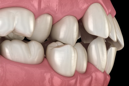 Featured image for “Can Orthodontists Fix Protruding Teeth?”