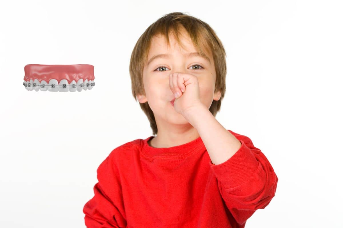 Featured image for “Why Do Children with Thumb-Sucking Need Braces?”