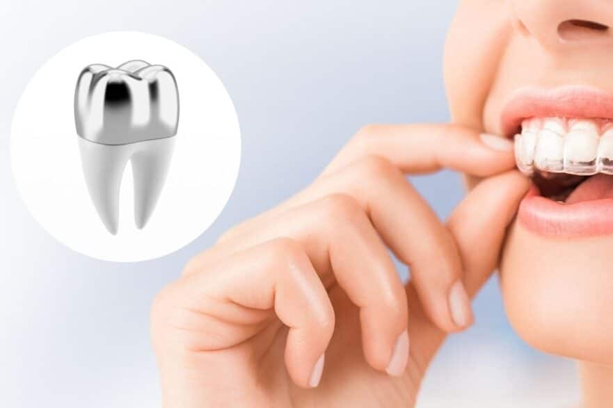 Get Invisalign with a Dental Crown