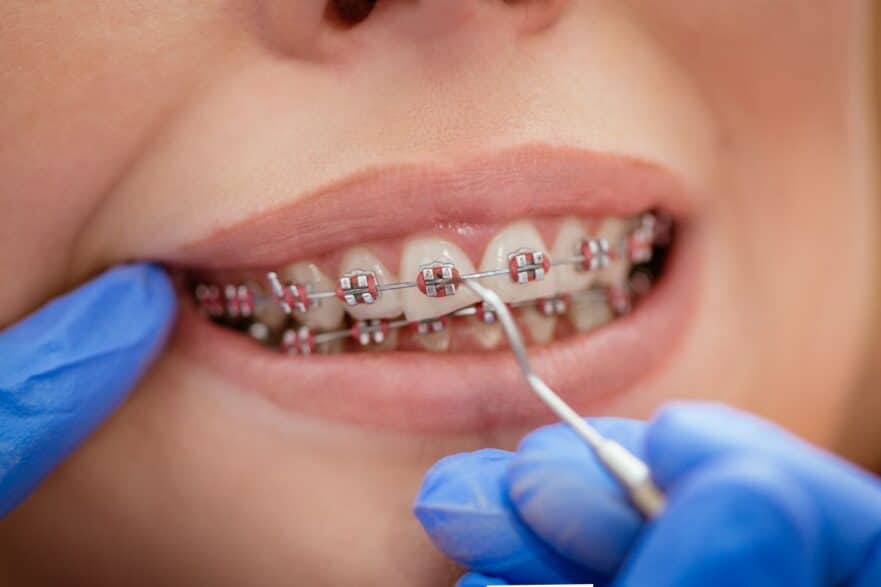 time frame for correcting malocclusion