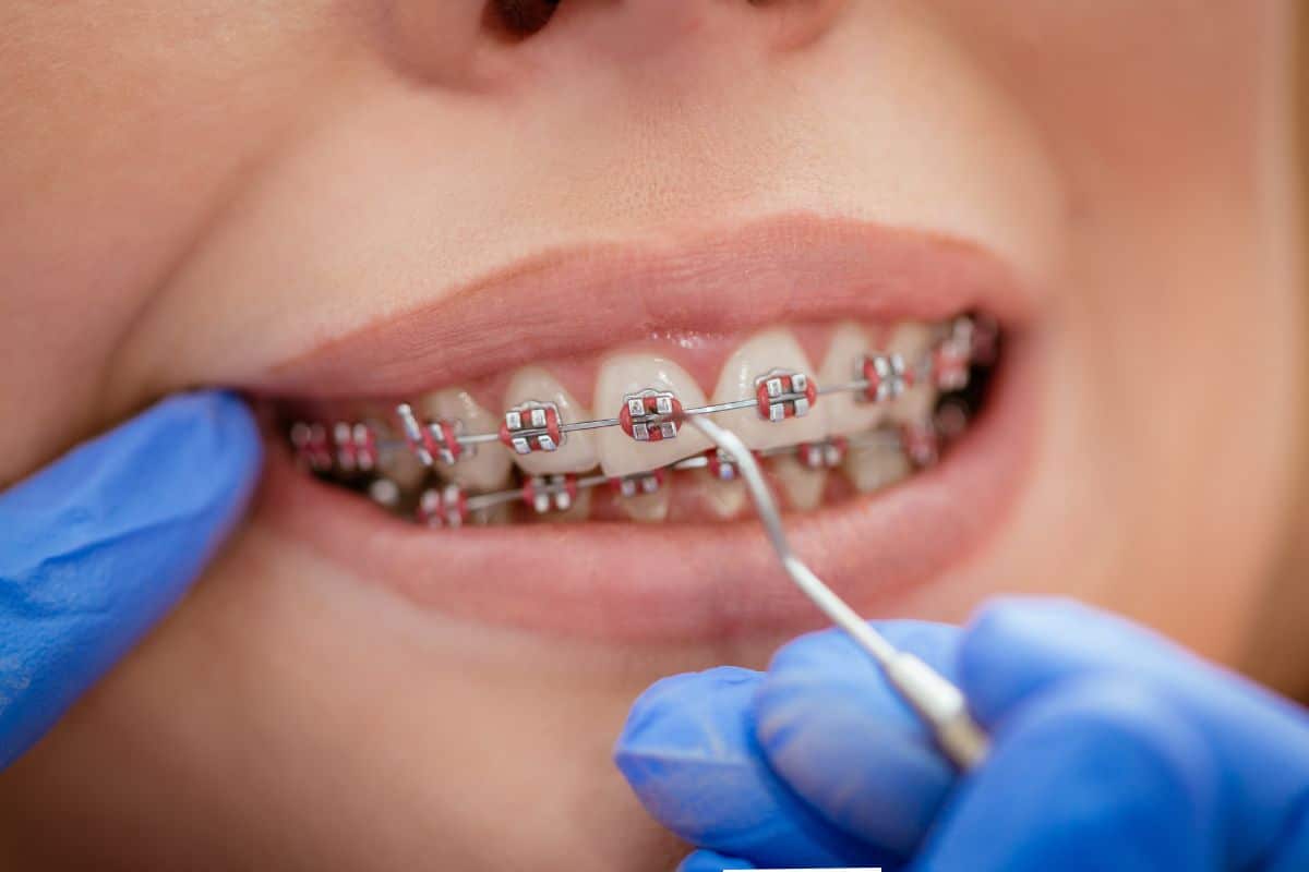 Featured image for “How Long Does It Take to Correct Malocclusion with Braces?”
