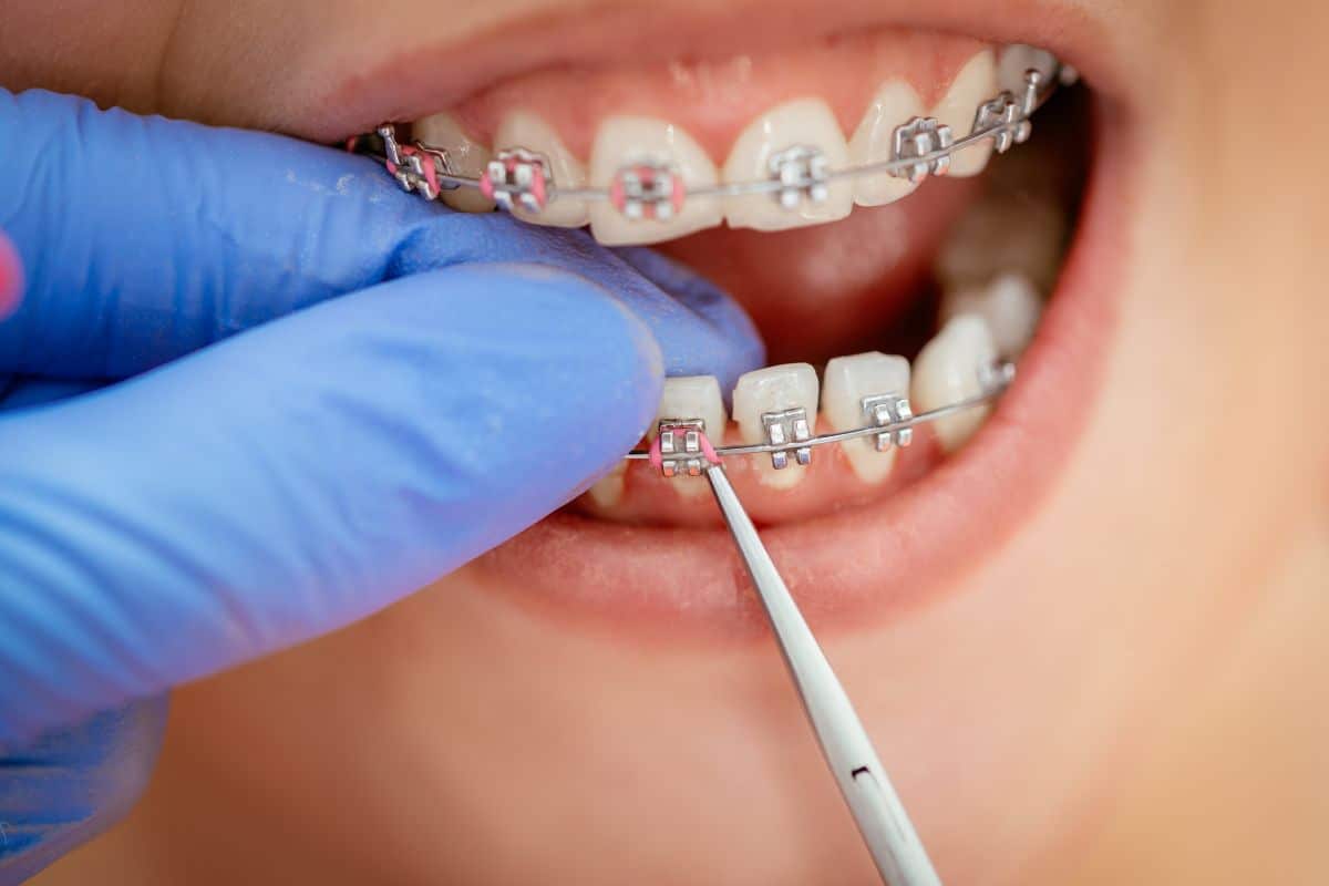 Featured image for “What to Do If Your Braces Wire Comes Out”