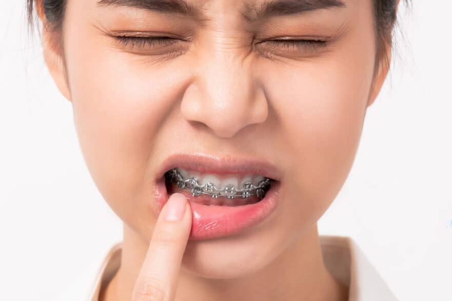 How Long Does The Pain From Braces Last