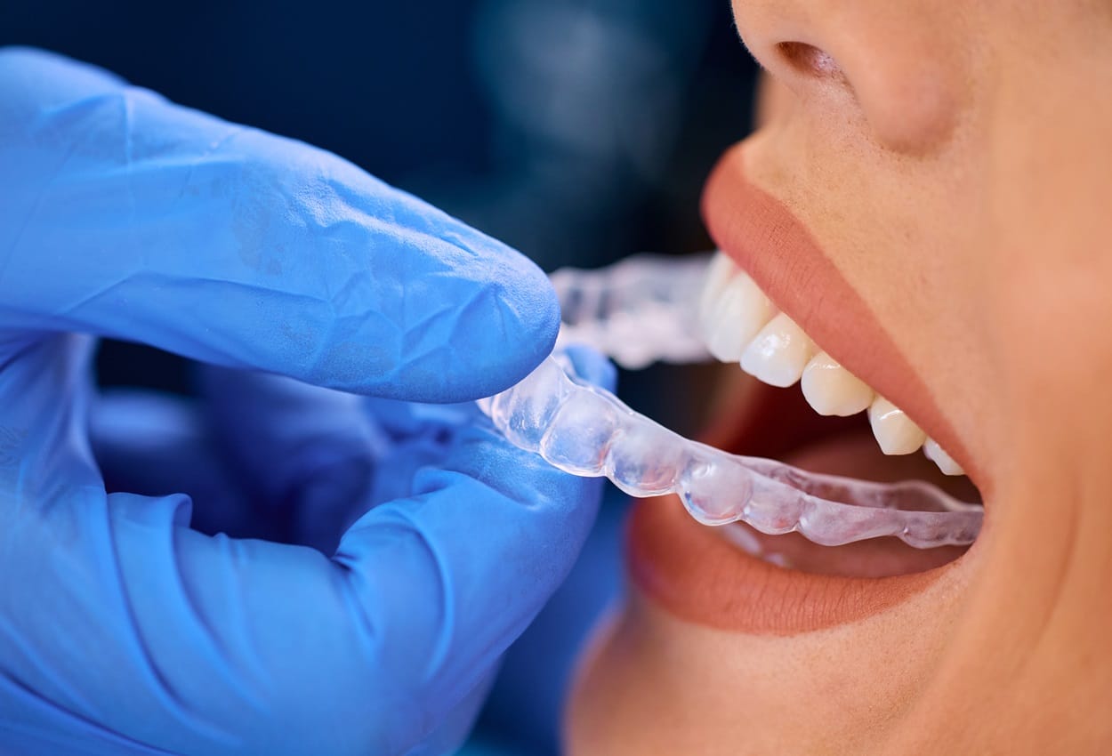 Featured image for “Independence Day and Invisalign: Start Your Journey to a Freer, Straighter Smile”