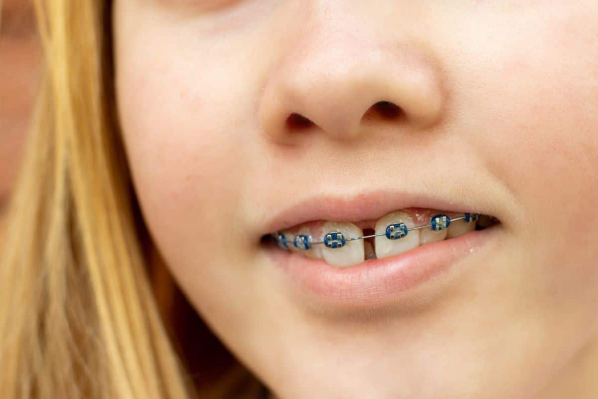 Featured image for “What to Do If Your Braces Cause Injury or Pain”