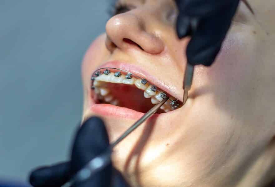 Dental Braces in Tompkinsville