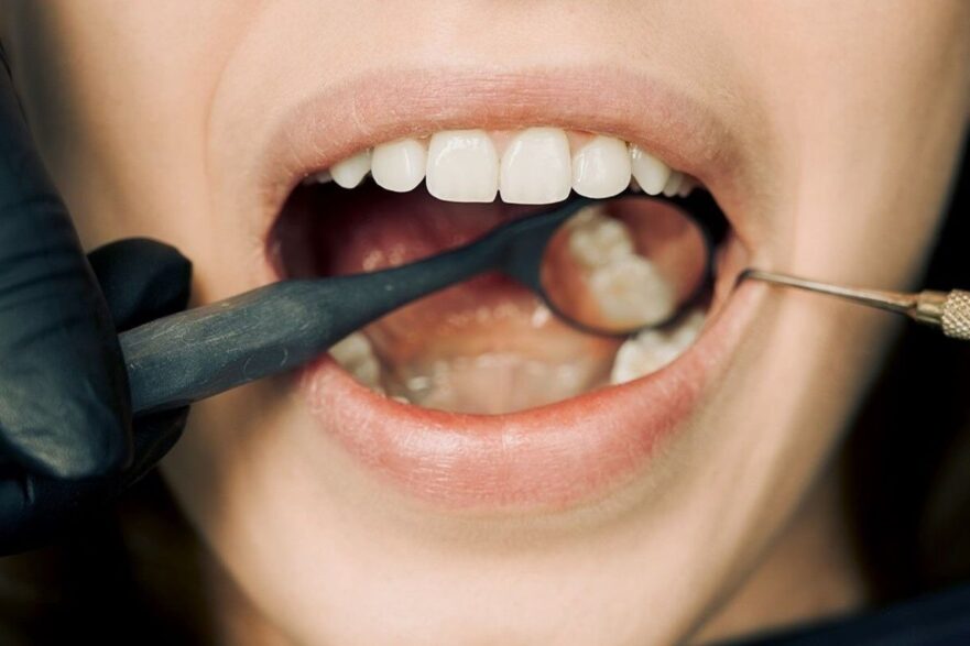 Can Wisdom Teeth Shift Your Teeth After Braces