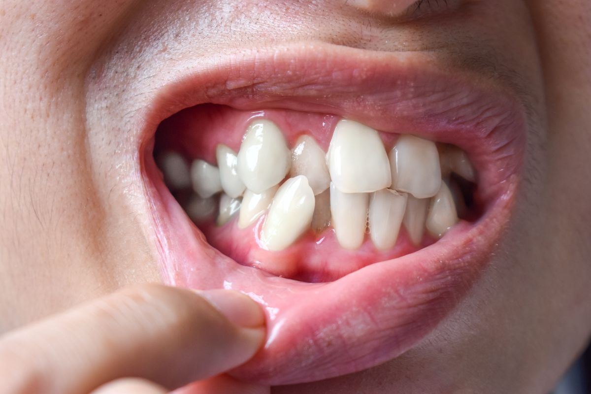 Featured image for “Does Fixing A Crossbite Change Face Shape?”