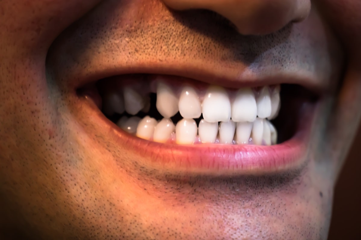 Featured image for “Living with a Crossbite: Daily Challenges and Solutions”
