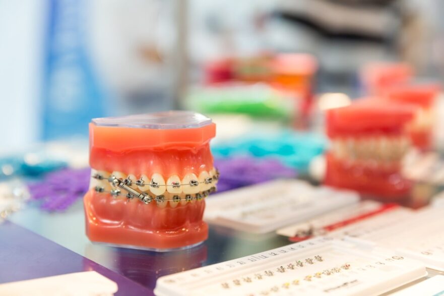 Eight Signs Its Time for Your Child to Get Braces