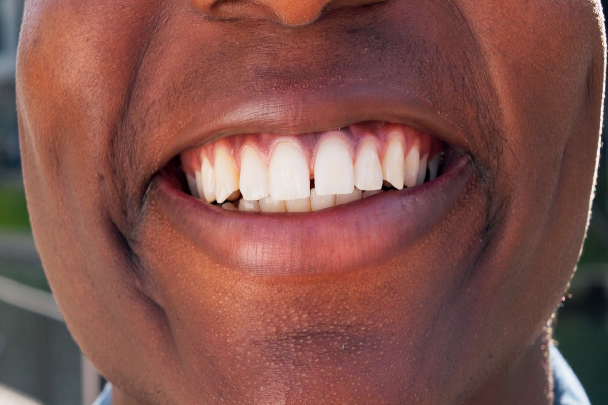 Featured image for “Excessive Spacing Between Teeth: When It’s a Problem”