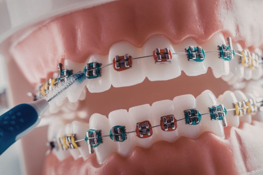 Damaged Braces for Sticky Candy