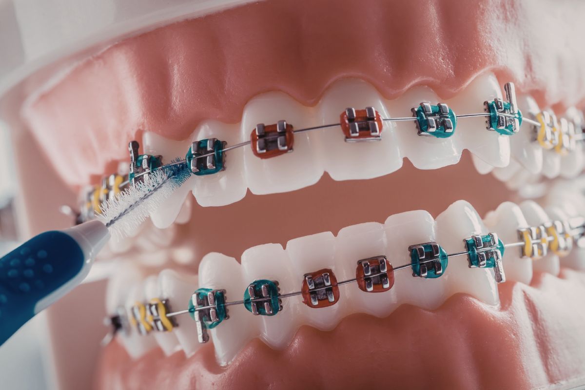 Featured image for “Will My Braces Get Damaged if I Eat Sticky Candy?”