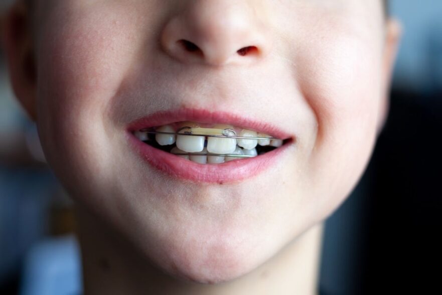 Overjet and Overbite Differences
