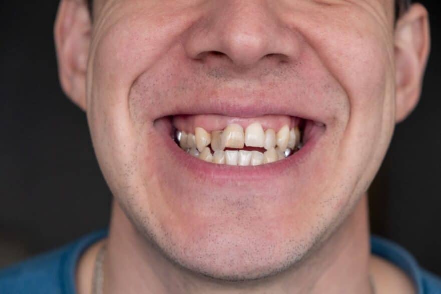 Fixing Crowded Teeth in Adults