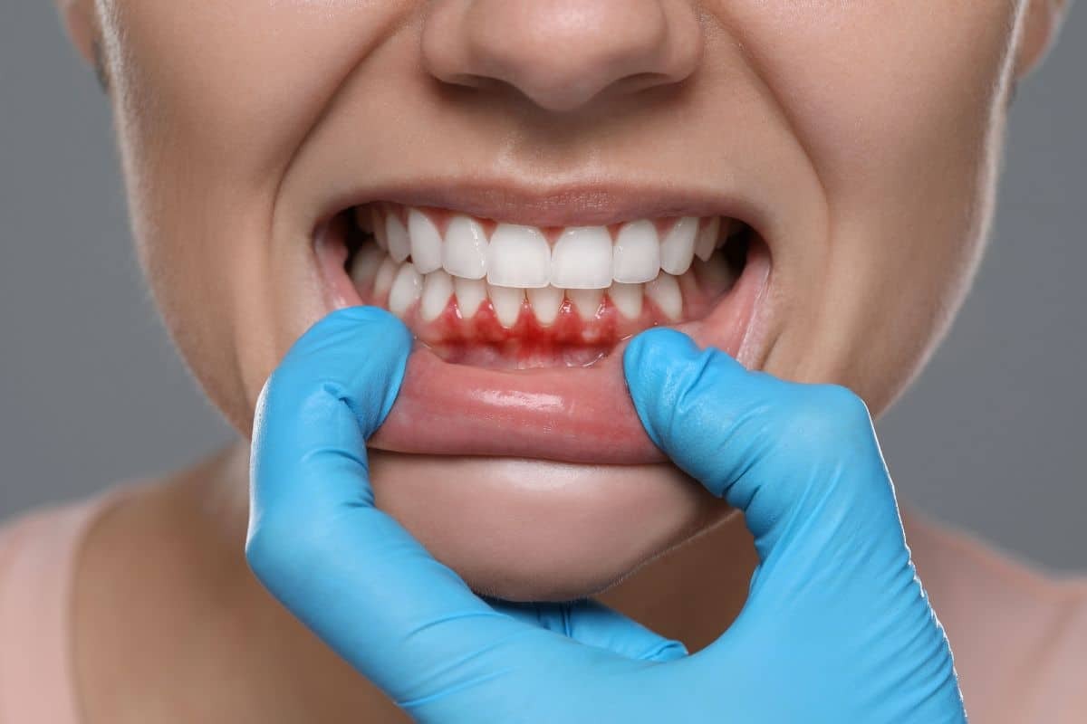 Featured image for “Sore Gums from Invisalign? Common Reasons and Easy Fixes”