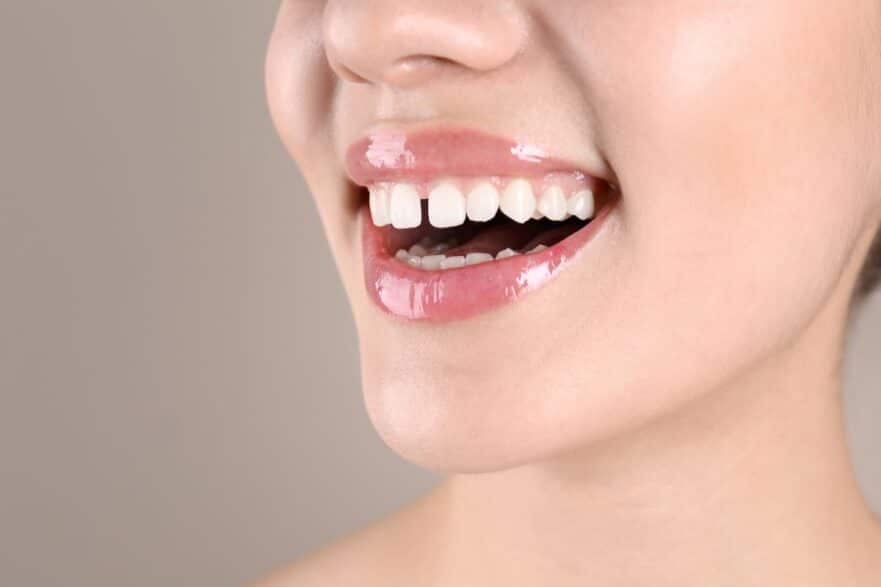 Front Teeth Not Touch